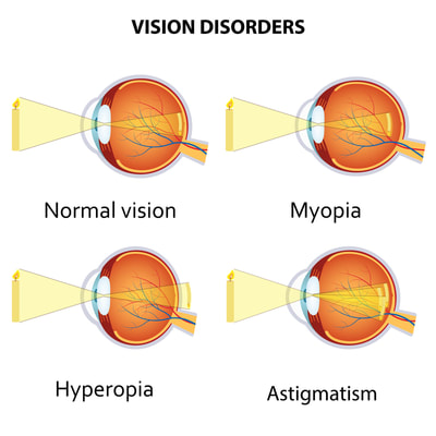 miopía astigmatismo hipermetropía presbicia